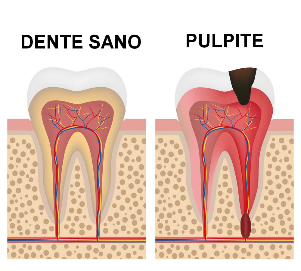 Pulpite Dentale - Cos'è, Cause e Come Curarla - Studio Biodental