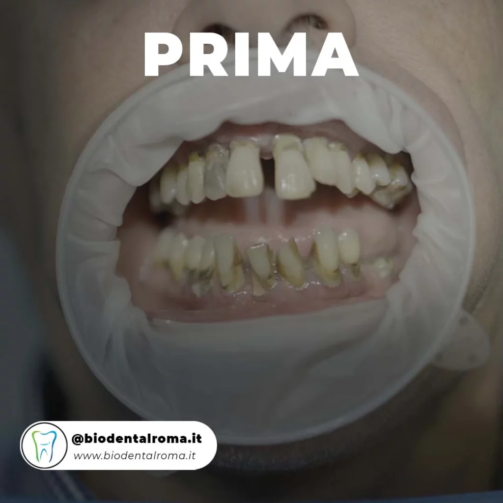 Impianto Dentale Roma - Prima e Dopo 1