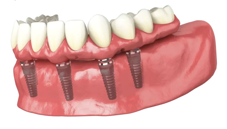 Impianti Dentali All on Four - Implantologia All on 4