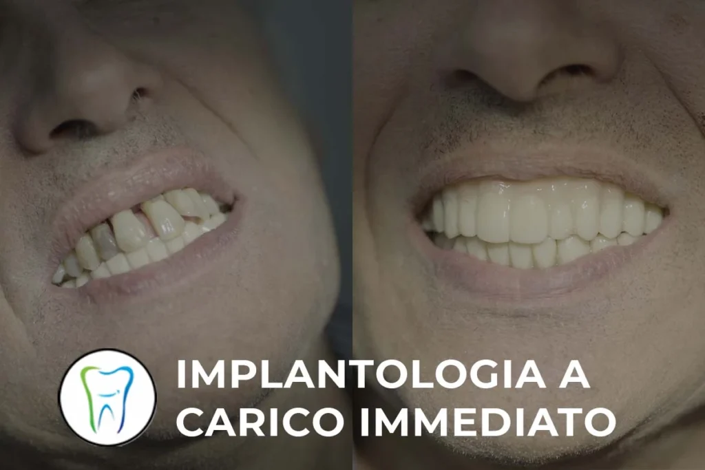 Implantologia a Carico Immediato - Impianto Dentale Carico Immediato Roma