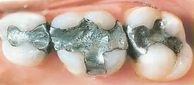 Otturazione Denti in Amalgama