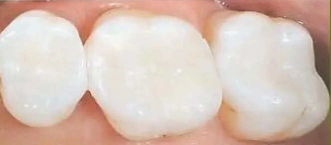 Otturazione Denti in Composito