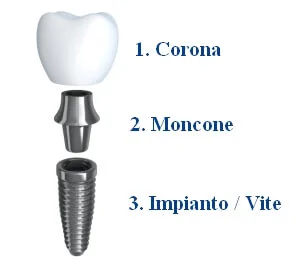 Costi di un Impianto Dentale - Impianto Dentale Costi